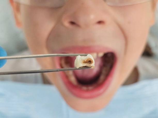 Best Emergency Tooth Extraction in Viera West, FL